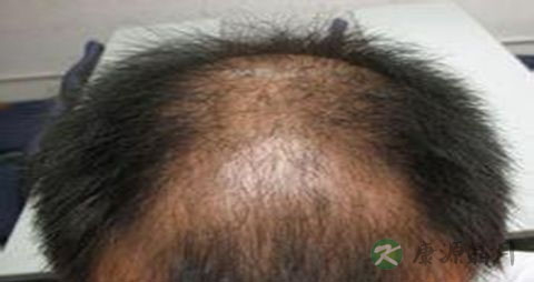 肾虚脱发严重怎么办