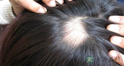 掉头发是什么原因