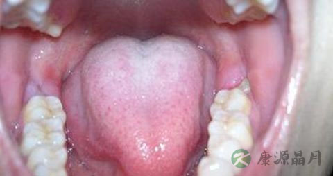 牙龈肿痛 吃什么