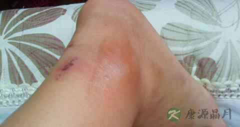 腿血栓吃什么食物好