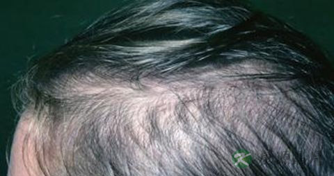 遗传性脱发症状