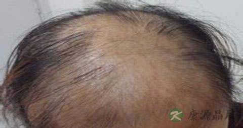 感染性脱发症状