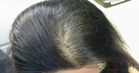 女性脱发怎么治疗