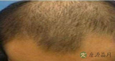 油脂性脱发怎么治