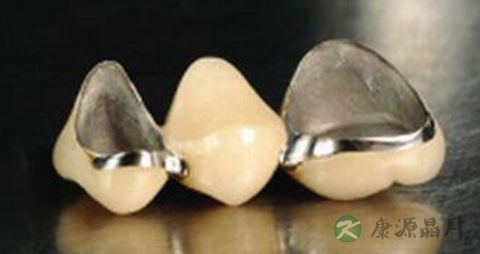 镍铬烤瓷牙多少钱