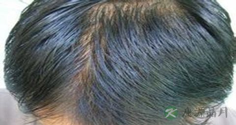 遗传脱发有救吗