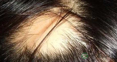 有效治疗脱发的方法