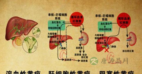 肝细胞性黄疸怎么治疗