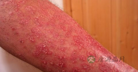 湿疹根治方法有哪些 湿疹根治方法有哪些