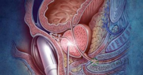 前列腺癌9级是晚期吗