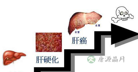 如何识别肝硬化？肝硬化的症状表现