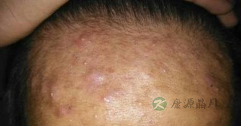 男人怎么去掉脸上的痘痘