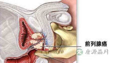 前列腺癌9级是晚期吗