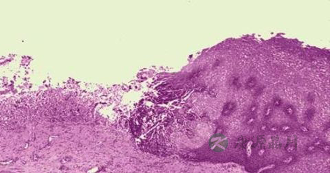 疱疹如何治疗 疱疹如何治疗