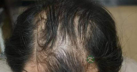 30岁的男人脱发怎么办 30岁的男人脱发怎么办