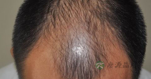 男人掉头发很厉害怎么办