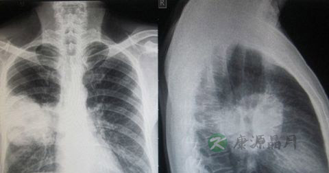 肺部肿瘤早期有什么症状