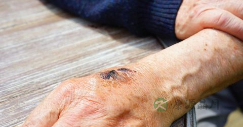 尖锐湿疣复发怎么办 尖锐湿疣复发怎么办