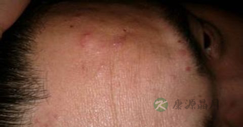 男人怎么去掉脸上的痘痘