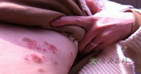 疱疹如何治疗 疱疹如何治疗
