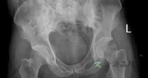 僵直性脊椎炎能治好吗? 僵直性脊椎炎能治好吗?