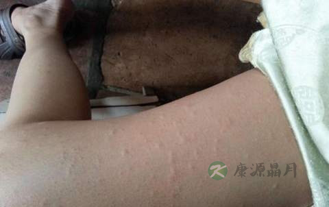 男人大腿内侧痒怎么办