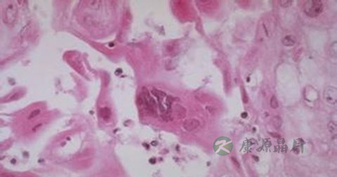 疱疹如何治疗 疱疹如何治疗