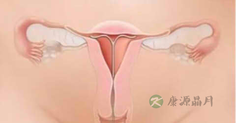 子宫轻微炎症是什么