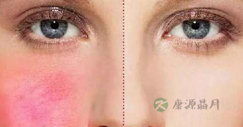 角质层薄吃猪蹄好吗