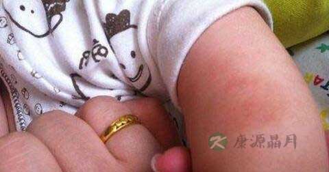 新生儿痤疮和湿疹的区别