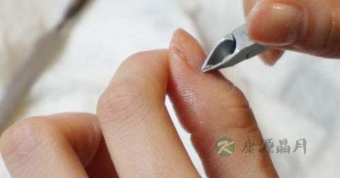 手指倒刺怎么办