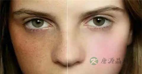 去黄褐斑面膜