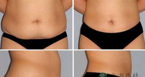 产后该如何护理腹部