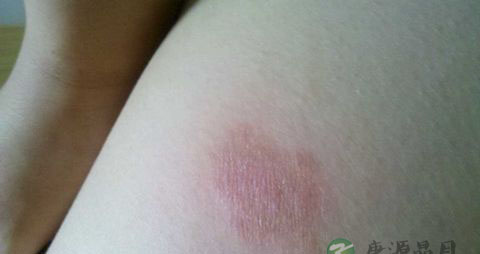 皮肤瘙痒是什么病