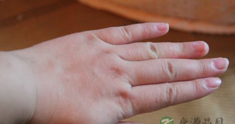 孕妇得了湿疹怎么办