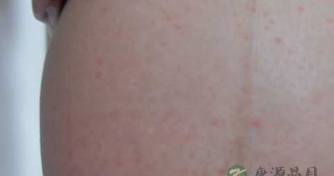 怀孕要怎么降总胆汁酸