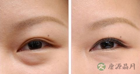 孕妇有眼袋怎么办？去除眼袋的方法