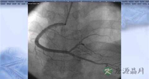 什么时候要做冠心病造影