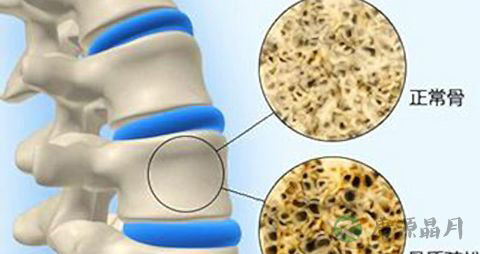 公主抱折断老伴3肋骨！严重骨质疏松怎么治疗