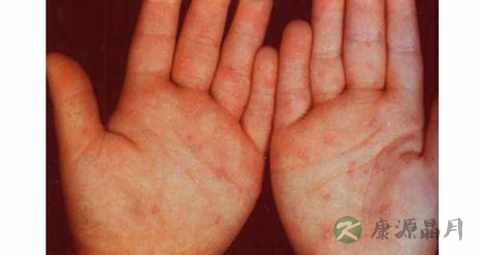 怎样预防幼儿手口足病