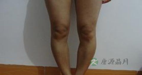 o型腿怎么矫正