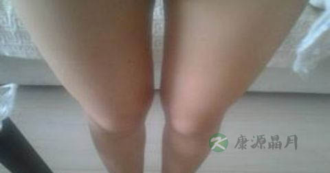 怎样减大象腿