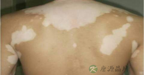 什么是白癜风