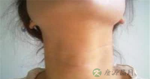 咽炎会导致淋巴肿大吗