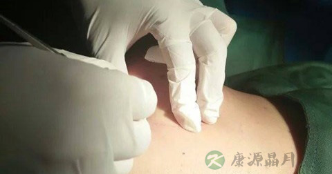 钩活术有风险吗