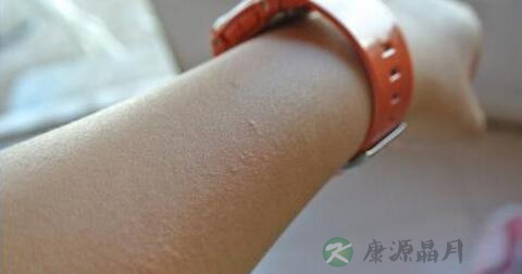 接触性皮炎的临床症状