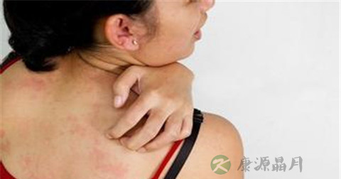 寒冷型荨麻疹是什么