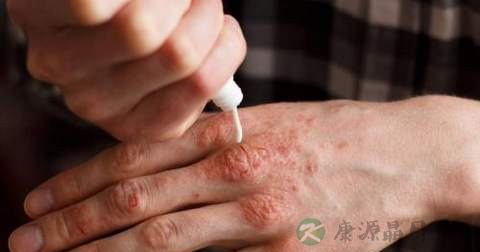 手臂出现白斑原因
