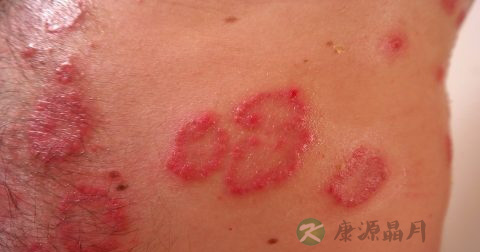 股癣用什么药