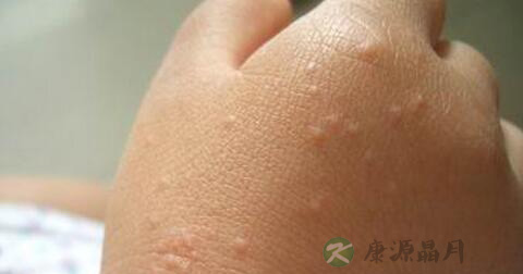 接触性皮炎的临床症状